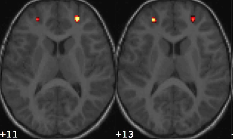 RMN Cerebrale
